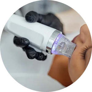 RF Micro-Needling at illumin8skin